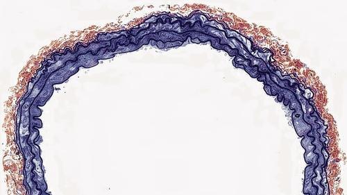 Verstopft und frei: Oben ein Blutgerinnsel in der Halsschlagader einer gesunden Maus, das sich nach einer Gefäßverletzung gebildet hat. Unten der Querschnitt durch die Halsschlagader einer Maus, der das Protein Kindlin-3 fehlt. Obwohl auch dieses Gefäß geschädigt ist, bildet sich kein Thrombus.
