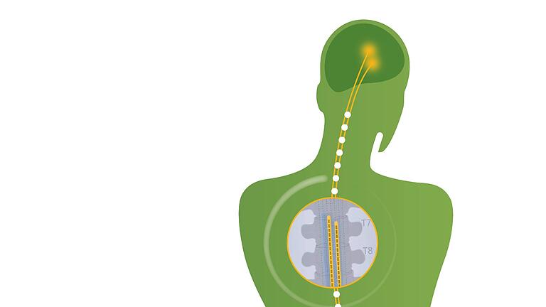 Schmerzstopper: Die Grafik zeigt links unten den Impulsgeber, dessen elektrische Impulse die Schmerzsignale auf ihrem Weg zum Gehirn unterbrechen (großer Kreis).