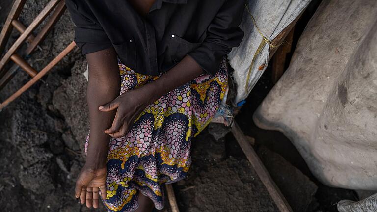 Mpox-Ausbrüche - Kongo       -  In Afrika gibt es schon 14.000 Mpox-Verdachtsfälle.