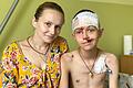 Der 13-jährige Stas (im Bild mit seiner Schwester) aus der Oblast Charkiw trug 2022 bei einem Beschuss seines Heimatortes schwere Kopfverletzungen davon. Im Rehabilitionszentrum 'Unbroken' in Würzburgs ukrainischer Partnerstadt Lwiw wurde er versorgt.