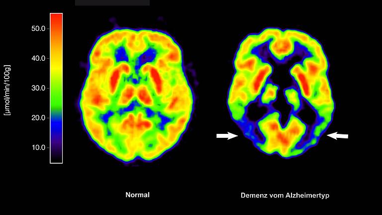 Alzheimer-Erkrankung       -  Lecanemab richtet sich gegen Amyloid-Ablagerungen im Gehirn und soll dadurch den Verlauf der Krankheit ein wenig verlangsamen. (Archivbild)