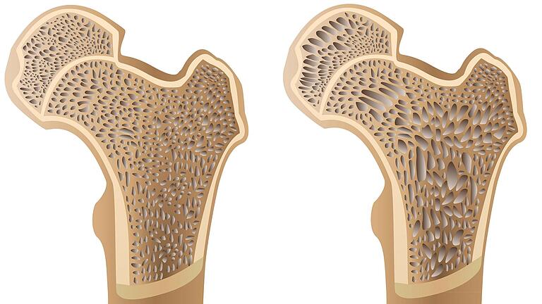 Ein normaler Knochen (links) und ein Knochen mit Osteoporose. Ein normaler Knochen (links) und ein Knochen mit Osteoporose.