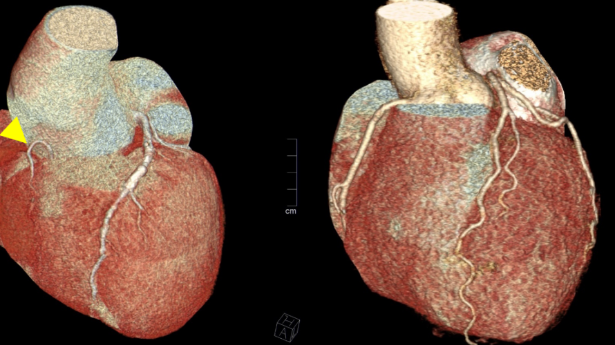 Röntgenjahr 2020       -  Anhand der 3D-Darstellung der Computertomographie des Herzens können die Herzkranzarterien nicht-invasiv dargestellt werden. Die gelbe Markierung zeigt im ersten Bild eine sehr schmächtig Arterie im Stromgebiet der rechten Herzkranzarterie (RCA), währende die linke Herzkranzarterie (LAD) normalkalibrig zu erkennen ist. Zum Vergleich ist im rechten Bild die normale Koronar-Anatomie eines anderen Patienten zu sehen.