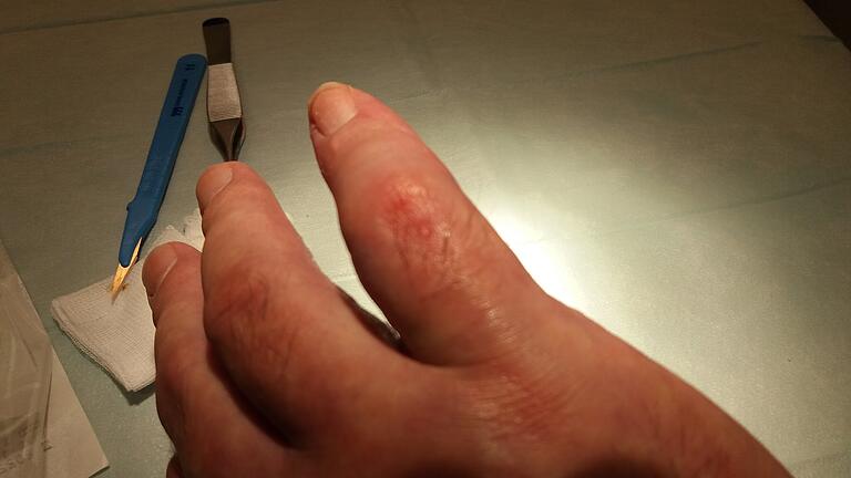 Verkrümmter Finger: Michael Klein muss damit leben. Verkrümmter Finger: Michael Klein muss damit leben. 
