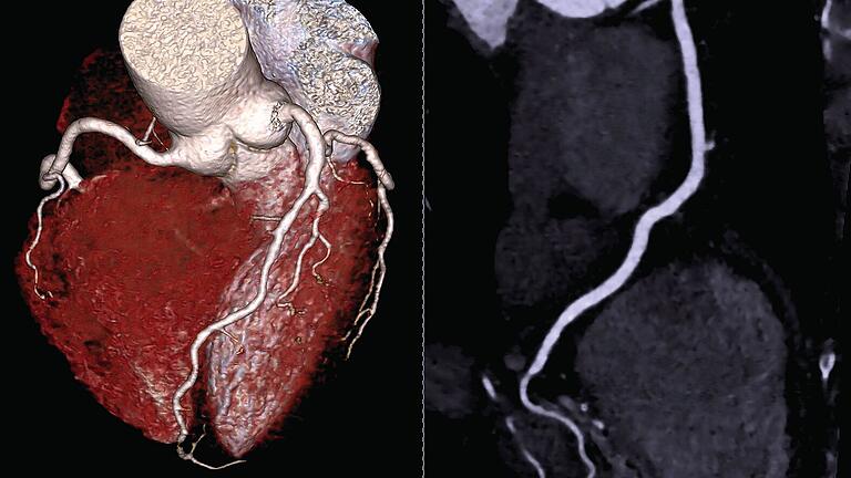Moderne Röntgenverfahren liefern hochpräzise Aufnahmen des Körpers. Die CT-Aufnahme zeigt ein gesundes menschliches Herz mit seinen Blutgefäßen.