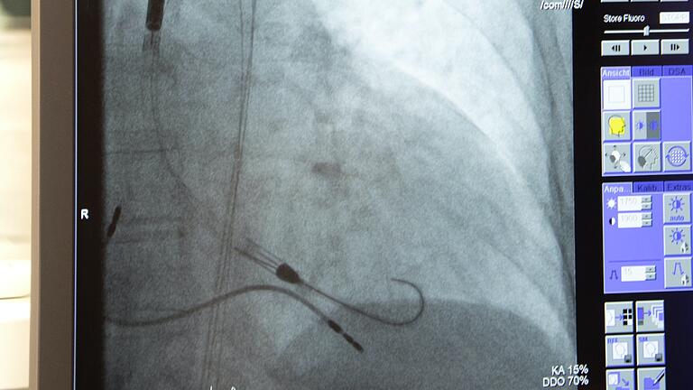 Die Herzpumpe, links zu erkennen, wird in linke Herzkammer eingeführt und pumpt von dort Blut in die Aorta. Die Herzpumpe, links zu erkennen, wird in linke Herzkammer eingeführt und pumpt von dort Blut in die Aorta.