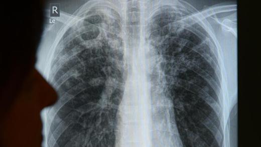 Tuberkulose       -  Die Infektionskrankheit Tuberkulose ist auch in Europa längst nicht ausgerottet. Foto: Rainer Jensen/Archiv