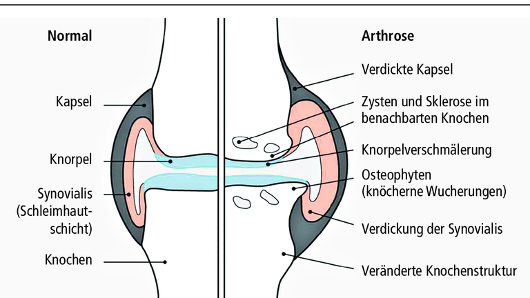 Volkskrankheit Arthrose