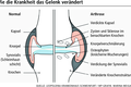 Volkskrankheit Arthrose