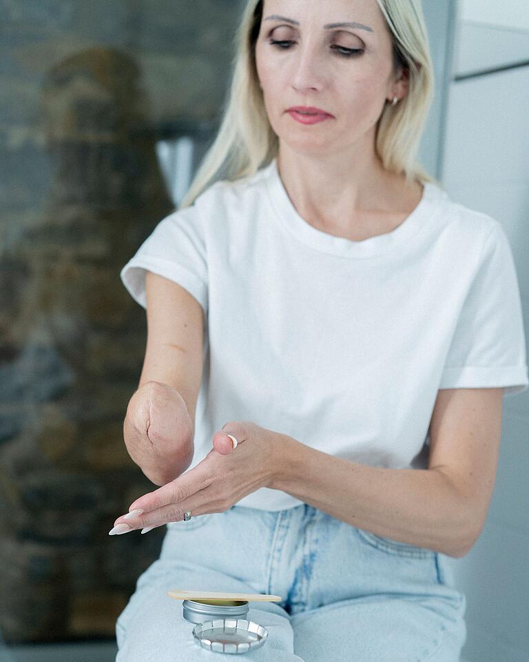 Wioletta Wyrwol pflegt ihre Amputationsnarbe mit der Ringelblumensalbe aus Kitzingen. Wioletta Wyrwol pflegt ihre Amputationsnarbe mit der Ringelblumensalbe aus Kitzingen.