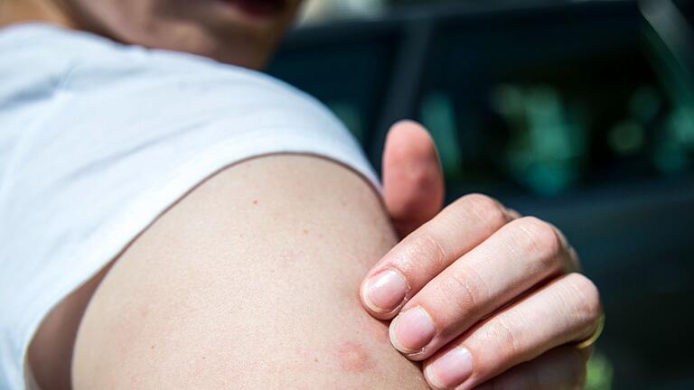 Eine Frau wurde von einem Insekt gestochen - So fies er auch juckt: An einem Mückenstich sollte man nicht herumkratzen. Eine Frau wurde von einem Insekt gestochen - So fies er auch juckt: An einem Mückenstich sollte man nicht herumkratzen.