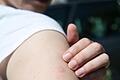 Auch wenn es juckt: An Mückenstichen nicht herumkratzen, sondern sie lieber kühlen. Foto: Andrea Warnecke/dpa-tmn       -  Auch wenn es juckt: An Stichen sollte man nicht herumkratzen.
