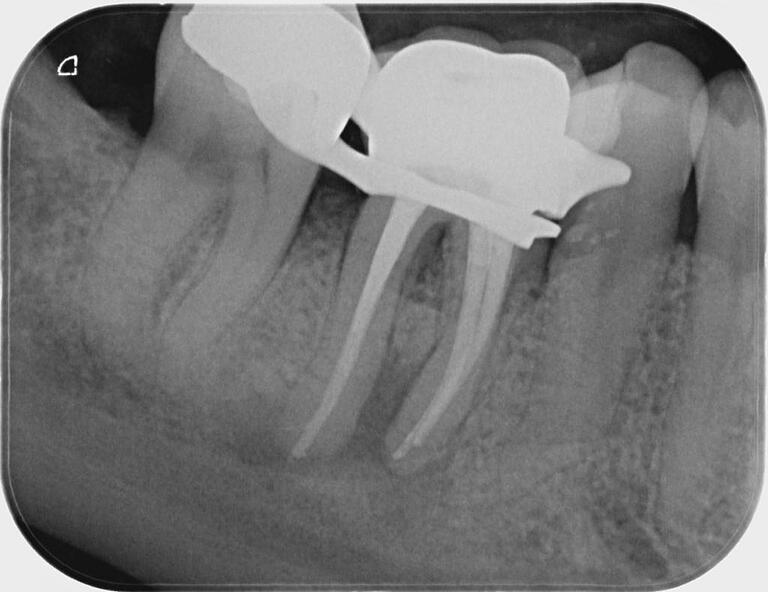 Ein Beispiel für eine exzellente endodontische Leistung: Die preiswürdige, von Lisanne Carnier durchgeführte Wurzelkanalbehandlung. Ein Beispiel für eine exzellente endodontische Leistung: Die preiswürdige, von Lisanne Carnier durchgeführte Wurzelkanalbehandlung.