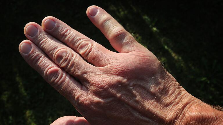 Schwellung nach einem Wespenstich - Eine Schwellung von bis zu 10 Zentimetern Durchmesser ist nach einem Wespenstich normal. Schwellung nach einem Wespenstich - Eine Schwellung von bis zu 10 Zentimetern Durchmesser ist nach einem Wespenstich normal.