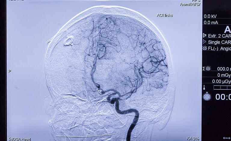 Blick ins Gehirn eines&nbsp; Patienten: Die Ärzte haben eine lebensbedrohliche Gefäßaussackung (Aneurysma) mit Metallspiralen ausgeschaltet.&nbsp;&nbsp;