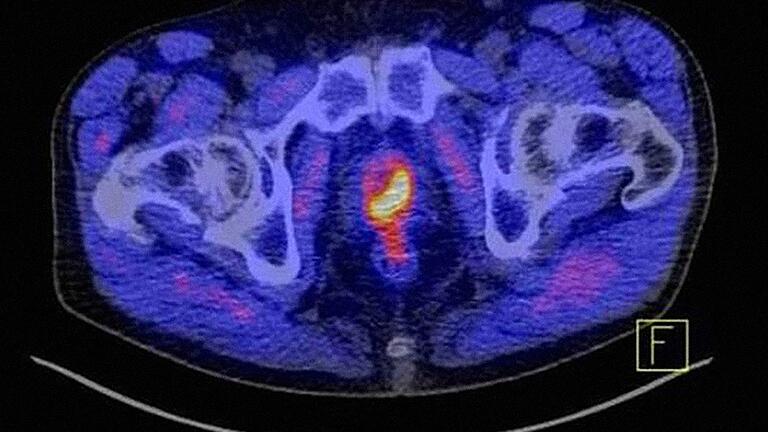 Diagnostik und Behandlung von Krebs werden über das Nationale Tumorzentrum in Würzburg stark ausgebaut. Die Abbildung zeigt ein&nbsp; Prostatakarzinom über eine spezielle Computertomografie.&nbsp;