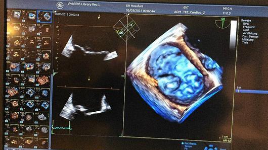 Der neue Herz-Ultraschall liefert dreidimensionale und farbige Bilder. Zum Vergleich sind links die zweidimensionalen Aufnahmen zu sehen.