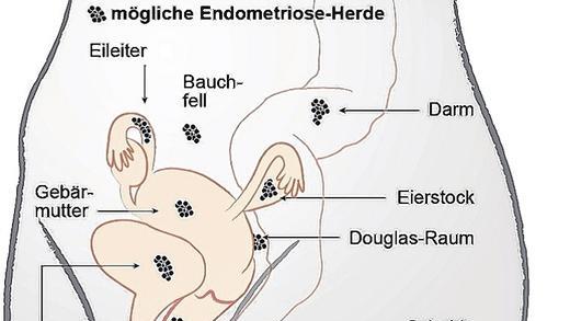 Überall im Bauch: Endometriose-Herde nisten sich an Organen an.