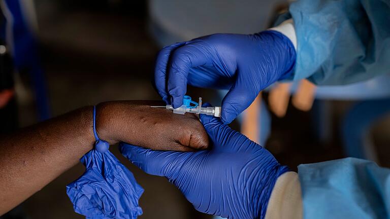 Mpox-Ausbrüche - Kongo - Ein erster Fall von Mpox ist in Deutschland nachgewiesen worden (Foto Archiv) Mpox-Ausbrüche - Kongo - Ein erster Fall von Mpox ist in Deutschland nachgewiesen worden (Foto Archiv)