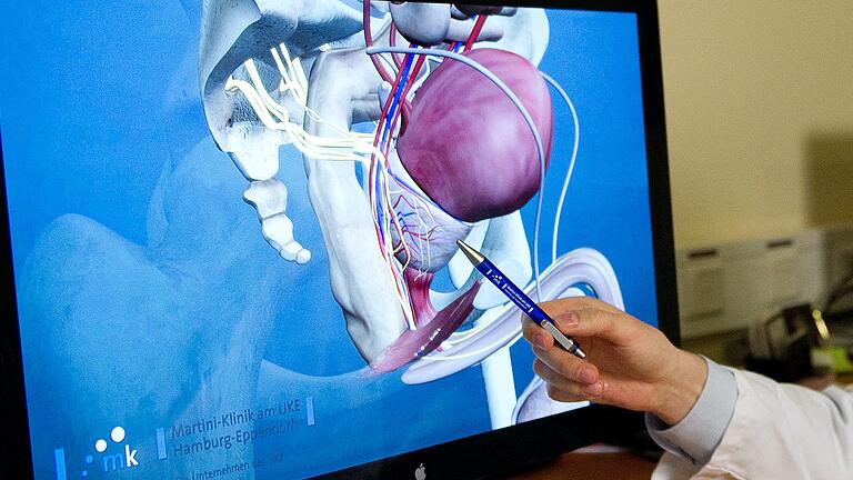 Ein Arzt zeigt in einem 3-D-Modell die Prostata. Sitzt dort ein Tumor, muss dieser nicht immer entfernt werden. Die Ärzte entscheiden je nach Größe des Karzinoms – und auch nach Alter des Patienten. Ein Arzt zeigt in einem 3-D-Modell die Prostata. Sitzt dort ein Tumor, muss dieser nicht immer entfernt werden. Die Ärzte entscheiden je nach Größe des Karzinoms – und auch nach Alter des Patienten. 
