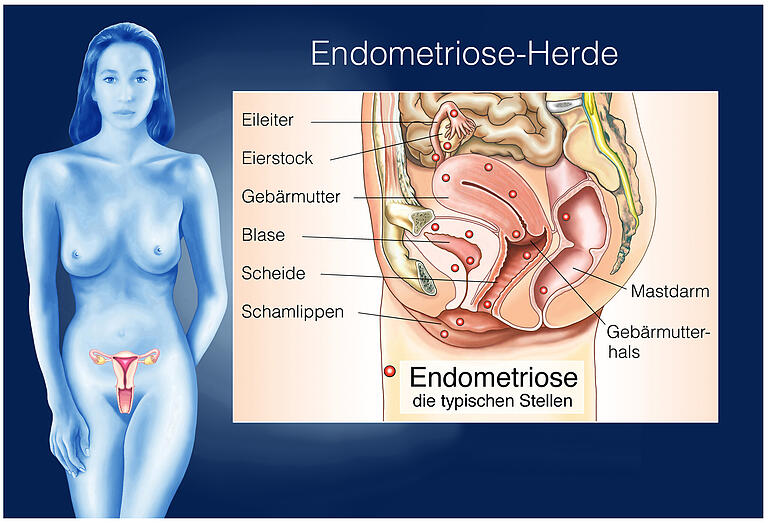 Endometriose: Was Frauen über die Krankheit wissen sollten Endometriose: Was Frauen über die Krankheit wissen sollten