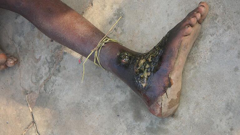 Typische offene Wunde bei Buruli Ulcer, der 'kleinen Schwester' der Lepra. Die Krankheit führt unbehandelt zu dauerhaften Verkrüppelungen und Behinderungen. Typische offene Wunde bei Buruli Ulcer, der 'kleinen Schwester' der Lepra. Die Krankheit führt unbehandelt zu dauerhaften Verkrüppelungen und Behinderungen.