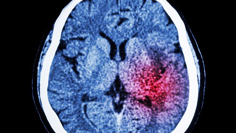 Eine Computertomografie des Gehirns macht den Schlaganfall sichtbar.&nbsp;