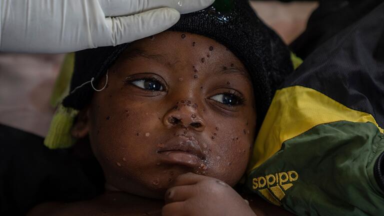 Mpox im Kongo - Ein an Mpox erkrankter zweijähriger Junge liegt in einem Krankenhaus in Kamituga im Osten des Kongo. Mpox im Kongo - Ein an Mpox erkrankter zweijähriger Junge liegt in einem Krankenhaus in Kamituga im Osten des Kongo.