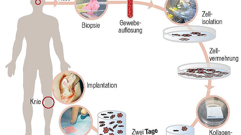 Knorpel wächst im Knie nicht nach. Im Labor aber schon. Würzburger Wissenschaftler stellen neues Gewebe für Transplantationen her. Man nehme Zellen aus der Nase und mache daraus welche fürs Knie. Was ein bisschen nach Frankenstein klingt, testet das EU Forschungsprojekt Bio-Chip gerade an über 100 Patienten. Der Würzburger Part dabei: Im Translationszentrum des Fraunhofer-Instituts für Silicatforschung erzeugen Dr. Oliver Pullig und sein Team aus den Zellen der Nase das Implantat fürs Knie. Das sechs Millimeter Durchmesser große Stückchen Nasenknorpel ist am Vortag in Basel ambulant einen Menschen mit einer Knieknorpelverletzung entnommen worden. Ein Bote hat es über Nacht nach Würzburg gefahren. In zweieinhalb Wochen wird ein drei mal vier Zentimeter großes Implantat zurück nach Basel geschickt. „Das ist dann das fünfzehnte, berichtet Privatdozent Pullig. Die ersten Knie-Ersatzteile haben Würzburg Mitte 2017 verlassen. Rund fünf Millionen Euro investiert die EU in das Projekt „Biotechnologisch erzeugte Implantate zur Knorpelheilung bei Patienten“. Beteiligt sind daran Forschungseinrichtungen in Basel, Freiburg, Mailand, Zagreb und Würzburg. Im Reinraumlabor der Kinderklinik des Würzburger Universitätsklinikums zerkleinert Tanja Kraus das stecknadelkopfgroße Knorpelstückchen vorsichtig mit dem Skalpell. Sie arbeitet im „Allerheiligsten“ des gesamten Prozesses, zu dem nur eine Handvoll Mitarbeiter Zugang haben. Den „Hochsicherheitstrakt“ betritt man in sterilen Gewändern, mit Mund- und Haarschutz. „Mit Schnupfen darf hier keiner rein“, erzählt die Biologisch-Technische Assistentin. Grund der strengen Hygienevorschriften: Was jetzt in der Petrischale isoliert, gewaschen und dann per Pipette in die winzige Vertiefungen einer Mikrotiterplatte verteilt wird, wächst in den nächsten Tagen zum Transplantat heran. Dieses wird dann in das Knie des Menschen eingepflanzt, dem der Nasenknorpel entnommen wurden. Jede fremde Zelle, jeder Erreger der sich jetzt unter diese Zellen mischen würde, könnte deren Wachstum stören. Oder – noch schlimmer – den fertigen, neuen „Ersatzknorpel“ verunreinigen, so dass es später im Knie zu schweren Entzündungsreaktionen kommen würde. „Für die bestmögliche Patientensicherheit müssen wir die gleichen strengen Qualitätsrichtlinien wie ein Pharmaunternehmen erfüllen. Das gilt für die Produktion im Reinraumlabor ebenso wie für die bis ins kleinste Detail definierte Abläufe des gesamten Verfahrens und den hohen Dokumentationsaufwand“, erklärt der Biologie Pullig. Da er bereits andere medizinische Forschungsprojekte geleitet hat, ist ihm dieses Thema nicht fremd. Aber: „Dieses Mal sind wir natürlich sehr nah am Patienten.“ Als nächster Schritt im Reinraumlabor kommt das Enzym Kollagenase zum Einsatz. Es löst im zerkleinerten Gewebe die Matrix auf, in der Zellen eingebettet sind. Anschließend werden diese gewaschen und per Pipette tröpfchenweise in die Vertiefungen einer Mikrotiterplatte gesetzt. Jetzt geht es in den Brutschrank. Bei 37 Grad teilen sich die Zellen. „Wie schnell sie das tun, ist je nach Patienten unterschiedlich“, weiß Assistentin Kraus. Knorpel ist ein Wunderwerk des Körpers. Das Stützgewebe ist elastisch und fest zugleich. Beim Treppe steigen muss das Kniegelenk eine 80 Kilogramm schweren Menschen 280 Kilogramm Gewicht aushalten. Sein reibungsloses Funktionieren garantiert der Knorpel zwischen den Knochen. Die Knorpelzellen sind in die Matrix eingebettet, die hauptsächlich aus Wasser, gequollenen Zuckereiweißen und kollagenen Fasern besteht. Sie verleihen dem Knorpel die typische Robustheit gegen Zug- und Scherkräfte und gleichzeitig die Geschmeidigkeit eines Miniaturwasserbetts: Bei Belastung entweicht Wasser ins Gelenk, bei Entlastung strömt es wieder zurück. Zwei weitere wichtige Eigenschaften hat Knorpel: Ihn Durchziehen keine Nerven, Beschädigungen spürt man deshalb lange nicht – selbst wenn sich Gewebepartikel zu lösen und gefährlich zu scheuern beginnen. Erst wenn sich die etwa sechs Millimeter dicke Knorpelschicht im Knie soweit abgebaut hat, dass die Schleimhaut anschwillt, meldet sich der Schmerz. Dann ist die Arthrose (Gelenkverschleiß) aber schon sehr weit fortgeschritten. Außerdem fließt kein Blut durch den Knorpel. Seine Zellen werden nur langsam durch Diffusion versorgt. Rasche Zellerneuerung, zu der zum Beispiel die Haut fähig ist, kann Knorpelgewebe nicht. Im Labor ist das möglich. Etwa eine Woche nach der Biopsie sind die Zellen im Brutschrank so gut gewachsen, dass sie umgesiedelt werden können. Tanja Kraus verteilt sie vorsichtig auf vier Plastikflaschen. Diese sind mit einer Nährlösung gefüllt, die mit Wachstumsfaktoren und dem Serum des Patienten angereichert wurde. Dieses wässrige Medium versorgt die Zellen mit allem was sie brauchen, um sich weiter zu teilen. Der Aufwand Knorpelgewebe außerhalb des Körpers zu züchten ist also groß, aber gleichzeitig eine große Chance. Denn Knorpelschäden sind eine Volkskrankheit. So gibt die Apotheken Umschau an, dass die Kniegelenke von rund zu fünf Millionen Deutsche geschädigt sind. „Unsere Zielgruppe sind aber keine Patienten mit Arthrose, sondern Patienten mit örtlich begrenzten, klar umrissenen Knorpeldefekten, wie sie nach Unfällen oder Sportverletzungen auftreten“, stellt Biologe Pullig klar. Denn nur bei diesen sei noch genug gesundes Knorpelgewebe vorhanden, um das gezüchtete Gewebe auch dauerhaft am Patientenknorpel zu befestigen. „Bei fortgeschrittener Arthrose geht das leider nicht, da zu wenig Knorpelschicht da ist.“ Im Reinraumlabor löst Tanja Kraus nach einer Woche die Zellen mit dem Enzym Trypsin vom Boden der Flaschen. Dann kommt ein winziges Tröpfchen auf einen speziellen Objektträger. Dieser ist in genormte Volumina unterteilt, die sogenannten Zählkammern. Unter dem Lichtmikroskop zählen zwei Mitarbeiterinnen wie viele lebende Zellen in dieser Kammer sind und rechnen mit diesem Wert die Anzahl der vermehrten Zellen aus. „Wenn wir 50 Millionen haben, ist das eine gute Ausgangslage“, erklärt Laborfachfrau Kraus. Bislang sei das bei allen Proben gelungen. „In der Regel haben wir sogar mehr als die nötigen 50 Millionen“. „Die Knorpelzellen aus der Nase sind denen des Knies sehr ähnlich“, erläutert Pullig. „Sie sind mechanisch belastbar und sie lassen sich auch bei älteren Patienten besonders gut vermehren.“ Außerdem erfolgt der Schnitt in die Nase ambulant und das ohnehin schon angegriffene Knie des Patienten muss nicht verletzt werden. Und der dritte Vorteil: Die vermehrten Nasenzellen bilden in vitro, außerhalb des Organismus, Knorpelgewebe aus. Das ist der nächste Schritt im Reinraumlabor. Die rund 50 Millionen Knorpelzellen werden auf ein drei mal vier Zentimeter große Stück Membran aus Schweine-Collagen gegeben. Diese Strukturproteine bauen die menschlichen Zellen um, indem sie eigene knorpeltypische Proteine erzeugen, die bald die Membran durchziehen. In der klinischen Studie werden zwei Varianten verwendet: In einer lässt man die Knorpelzellen zwei Tage auf der Membran reifen, in der anderen zwei Wochen. „Ein Ziel der Studie ist, den Einfluss des Reifegrades auf die klinische Wirksamkeit zu untersuchen. Sollte die zweitägige Laborreifung für einen Therapieerfolg ausreichend sein, würde diese Beschleunigung helfen, das bislang noch sehr teure Herstellungsverfahren günstiger zu machen“, erläutert Pullig. Ebenso werden viele andere Faktoren des Prozesses – wie zum Beispiel Alter oder Körpergewicht der Patienten – untersucht. Die Zellen aus Basel reiften dieses Mal nur zwei Tag und zweieinhalb Wochen nach der Ankunft ist das Transplantat fertig. Die Endkontrolle hat stattgefunden, die Transportbox ist gekühlt, der Bote wartet im Auto. Währenddessen die veränderten Nasenzellen über die Autobahn zurück in die Schweiz fahren, begibt sich in Basel der Patient wieder ins Krankenhaus. Am Morgen wird ein Ärzteteam das Knie des Patienten öffnen und das gezüchtete Gewebe implantieren. 35 Knieverletzte haben bislang ein aus Nasenknorpel hergestelltes Transplantat eingepflanzt bekommen – Probleme gab es bislang keine. Doch erst am Ende der vierjährigen Studie wird man wissen, ob die in Würzburg hergestellten neuartigen Gewebe Knorpelverletzungen tatsächlich heilen. Knorpel wächst im Knie nicht nach. Im Labor aber schon. Würzburger Wissenschaftler stellen neues Gewebe für Transplantationen her. Man nehme Zellen aus der Nase und mache daraus welche fürs Knie. Was ein bisschen nach Frankenstein klingt, testet das EU Forschungsprojekt Bio-Chip gerade an über 100 Patienten. Der Würzburger Part dabei: Im Translationszentrum des Fraunhofer-Instituts für Silicatforschung erzeugen Dr. Oliver Pullig und sein Team aus den Zellen der Nase das Implantat fürs Knie. Das sechs Millimeter Durchmesser große Stückchen Nasenknorpel ist am Vortag in Basel ambulant einen Menschen mit einer Knieknorpelverletzung entnommen worden. Ein Bote hat es über Nacht nach Würzburg gefahren. In zweieinhalb Wochen wird ein drei mal vier Zentimeter großes Implantat zurück nach Basel geschickt. „Das ist dann das fünfzehnte, berichtet Privatdozent Pullig. Die ersten Knie-Ersatzteile haben Würzburg Mitte 2017 verlassen. Rund fünf Millionen Euro investiert die EU in das Projekt „Biotechnologisch erzeugte Implantate zur Knorpelheilung bei Patienten“. Beteiligt sind daran Forschungseinrichtungen in Basel, Freiburg, Mailand, Zagreb und Würzburg. Im Reinraumlabor der Kinderklinik des Würzburger Universitätsklinikums zerkleinert Tanja Kraus das stecknadelkopfgroße Knorpelstückchen vorsichtig mit dem Skalpell. Sie arbeitet im „Allerheiligsten“ des gesamten Prozesses, zu dem nur eine Handvoll Mitarbeiter Zugang haben. Den „Hochsicherheitstrakt“ betritt man in sterilen Gewändern, mit Mund- und Haarschutz. „Mit Schnupfen darf hier keiner rein“, erzählt die Biologisch-Technische Assistentin. Grund der strengen Hygienevorschriften: Was jetzt in der Petrischale isoliert, gewaschen und dann per Pipette in die winzige Vertiefungen einer Mikrotiterplatte verteilt wird, wächst in den nächsten Tagen zum Transplantat heran. Dieses wird dann in das Knie des Menschen eingepflanzt, dem der Nasenknorpel entnommen wurden. Jede fremde Zelle, jeder Erreger der sich jetzt unter diese Zellen mischen würde, könnte deren Wachstum stören. Oder – noch schlimmer – den fertigen, neuen „Ersatzknorpel“ verunreinigen, so dass es später im Knie zu schweren Entzündungsreaktionen kommen würde. „Für die bestmögliche Patientensicherheit müssen wir die gleichen strengen Qualitätsrichtlinien wie ein Pharmaunternehmen erfüllen. Das gilt für die Produktion im Reinraumlabor ebenso wie für die bis ins kleinste Detail definierte Abläufe des gesamten Verfahrens und den hohen Dokumentationsaufwand“, erklärt der Biologie Pullig. Da er bereits andere medizinische Forschungsprojekte geleitet hat, ist ihm dieses Thema nicht fremd. Aber: „Dieses Mal sind wir natürlich sehr nah am Patienten.“ Als nächster Schritt im Reinraumlabor kommt das Enzym Kollagenase zum Einsatz. Es löst im zerkleinerten Gewebe die Matrix auf, in der Zellen eingebettet sind. Anschließend werden diese gewaschen und per Pipette tröpfchenweise in die Vertiefungen einer Mikrotiterplatte gesetzt. Jetzt geht es in den Brutschrank. Bei 37 Grad teilen sich die Zellen. „Wie schnell sie das tun, ist je nach Patienten unterschiedlich“, weiß Assistentin Kraus. Knorpel ist ein Wunderwerk des Körpers. Das Stützgewebe ist elastisch und fest zugleich. Beim Treppe steigen muss das Kniegelenk eine 80 Kilogramm schweren Menschen 280 Kilogramm Gewicht aushalten. Sein reibungsloses Funktionieren garantiert der Knorpel zwischen den Knochen. Die Knorpelzellen sind in die Matrix eingebettet, die hauptsächlich aus Wasser, gequollenen Zuckereiweißen und kollagenen Fasern besteht. Sie verleihen dem Knorpel die typische Robustheit gegen Zug- und Scherkräfte und gleichzeitig die Geschmeidigkeit eines Miniaturwasserbetts: Bei Belastung entweicht Wasser ins Gelenk, bei Entlastung strömt es wieder zurück. Zwei weitere wichtige Eigenschaften hat Knorpel: Ihn Durchziehen keine Nerven, Beschädigungen spürt man deshalb lange nicht – selbst wenn sich Gewebepartikel zu lösen und gefährlich zu scheuern beginnen. Erst wenn sich die etwa sechs Millimeter dicke Knorpelschicht im Knie soweit abgebaut hat, dass die Schleimhaut anschwillt, meldet sich der Schmerz. Dann ist die Arthrose (Gelenkverschleiß) aber schon sehr weit fortgeschritten. Außerdem fließt kein Blut durch den Knorpel. Seine Zellen werden nur langsam durch Diffusion versorgt. Rasche Zellerneuerung, zu der zum Beispiel die Haut fähig ist, kann Knorpelgewebe nicht. Im Labor ist das möglich. Etwa eine Woche nach der Biopsie sind die Zellen im Brutschrank so gut gewachsen, dass sie umgesiedelt werden können. Tanja Kraus verteilt sie vorsichtig auf vier Plastikflaschen. Diese sind mit einer Nährlösung gefüllt, die mit Wachstumsfaktoren und dem Serum des Patienten angereichert wurde. Dieses wässrige Medium versorgt die Zellen mit allem was sie brauchen, um sich weiter zu teilen. Der Aufwand Knorpelgewebe außerhalb des Körpers zu züchten ist also groß, aber gleichzeitig eine große Chance. Denn Knorpelschäden sind eine Volkskrankheit. So gibt die Apotheken Umschau an, dass die Kniegelenke von rund zu fünf Millionen Deutsche geschädigt sind. „Unsere Zielgruppe sind aber keine Patienten mit Arthrose, sondern Patienten mit örtlich begrenzten, klar umrissenen Knorpeldefekten, wie sie nach Unfällen oder Sportverletzungen auftreten“, stellt Biologe Pullig klar. Denn nur bei diesen sei noch genug gesundes Knorpelgewebe vorhanden, um das gezüchtete Gewebe auch dauerhaft am Patientenknorpel zu befestigen. „Bei fortgeschrittener Arthrose geht das leider nicht, da zu wenig Knorpelschicht da ist.“ Im Reinraumlabor löst Tanja Kraus nach einer Woche die Zellen mit dem Enzym Trypsin vom Boden der Flaschen. Dann kommt ein winziges Tröpfchen auf einen speziellen Objektträger. Dieser ist in genormte Volumina unterteilt, die sogenannten Zählkammern. Unter dem Lichtmikroskop zählen zwei Mitarbeiterinnen wie viele lebende Zellen in dieser Kammer sind und rechnen mit diesem Wert die Anzahl der vermehrten Zellen aus. „Wenn wir 50 Millionen haben, ist das eine gute Ausgangslage“, erklärt Laborfachfrau Kraus. Bislang sei das bei allen Proben gelungen. „In der Regel haben wir sogar mehr als die nötigen 50 Millionen“. „Die Knorpelzellen aus der Nase sind denen des Knies sehr ähnlich“, erläutert Pullig. „Sie sind mechanisch belastbar und sie lassen sich auch bei älteren Patienten besonders gut vermehren.“ Außerdem erfolgt der Schnitt in die Nase ambulant und das ohnehin schon angegriffene Knie des Patienten muss nicht verletzt werden. Und der dritte Vorteil: Die vermehrten Nasenzellen bilden in vitro, außerhalb des Organismus, Knorpelgewebe aus. Das ist der nächste Schritt im Reinraumlabor. Die rund 50 Millionen Knorpelzellen werden auf ein drei mal vier Zentimeter große Stück Membran aus Schweine-Collagen gegeben. Diese Strukturproteine bauen die menschlichen Zellen um, indem sie eigene knorpeltypische Proteine erzeugen, die bald die Membran durchziehen. In der klinischen Studie werden zwei Varianten verwendet: In einer lässt man die Knorpelzellen zwei Tage auf der Membran reifen, in der anderen zwei Wochen. „Ein Ziel der Studie ist, den Einfluss des Reifegrades auf die klinische Wirksamkeit zu untersuchen. Sollte die zweitägige Laborreifung für einen Therapieerfolg ausreichend sein, würde diese Beschleunigung helfen, das bislang noch sehr teure Herstellungsverfahren günstiger zu machen“, erläutert Pullig. Ebenso werden viele andere Faktoren des Prozesses – wie zum Beispiel Alter oder Körpergewicht der Patienten – untersucht. Die Zellen aus Basel reiften dieses Mal nur zwei Tag und zweieinhalb Wochen nach der Ankunft ist das Transplantat fertig. Die Endkontrolle hat stattgefunden, die Transportbox ist gekühlt, der Bote wartet im Auto. Währenddessen die veränderten Nasenzellen über die Autobahn zurück in die Schweiz fahren, begibt sich in Basel der Patient wieder ins Krankenhaus. Am Morgen wird ein Ärzteteam das Knie des Patienten öffnen und das gezüchtete Gewebe implantieren. 35 Knieverletzte haben bislang ein aus Nasenknorpel hergestelltes Transplantat eingepflanzt bekommen – Probleme gab es bislang keine. Doch erst am Ende der vierjährigen Studie wird man wissen, ob die in Würzburg hergestellten neuartigen Gewebe Knorpelverletzungen tatsächlich heilen.