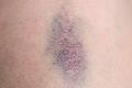 Ein Bluterguss auf einem Knie       -  Wenn bereits leichte Stöße häufig zu blauen Flecken führen, kann das auf eine Störung der Blutgerinnung hinweisen.