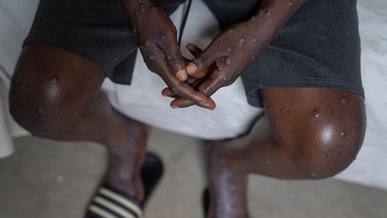 WHO ruft weltweite Notlage wegen Mpox aus       -  Typisch für Mpox ist ein Hautausschlag, der schmerzhaft sein kann. (Archivbild)