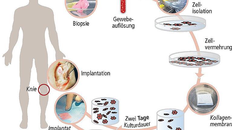 Knorpel wächst im Knie nicht nach. Im Labor aber schon. Würzburger Wissenschaftler stellen neues Gewebe für Transplantationen her. Man nehme Zellen aus der Nase und mache daraus welche fürs Knie. Was ein bisschen nach Frankenstein klingt, testet das EU Forschungsprojekt Bio-Chip gerade an über 100 Patienten. Der Würzburger Part dabei: Im Translationszentrum des Fraunhofer-Instituts für Silicatforschung erzeugen Dr. Oliver Pullig und sein Team aus den Zellen der Nase das Implantat fürs Knie. Das sechs Millimeter Durchmesser große Stückchen Nasenknorpel ist am Vortag in Basel ambulant einen Menschen mit einer Knieknorpelverletzung entnommen worden. Ein Bote hat es über Nacht nach Würzburg gefahren. In zweieinhalb Wochen wird ein drei mal vier Zentimeter großes Implantat zurück nach Basel geschickt. „Das ist dann das fünfzehnte, berichtet Privatdozent Pullig. Die ersten Knie-Ersatzteile haben Würzburg Mitte 2017 verlassen. Rund fünf Millionen Euro investiert die EU in das Projekt „Biotechnologisch erzeugte Implantate zur Knorpelheilung bei Patienten“. Beteiligt sind daran Forschungseinrichtungen in Basel, Freiburg, Mailand, Zagreb und Würzburg. Im Reinraumlabor der Kinderklinik des Würzburger Universitätsklinikums zerkleinert Tanja Kraus das stecknadelkopfgroße Knorpelstückchen vorsichtig mit dem Skalpell. Sie arbeitet im „Allerheiligsten“ des gesamten Prozesses, zu dem nur eine Handvoll Mitarbeiter Zugang haben. Den „Hochsicherheitstrakt“ betritt man in sterilen Gewändern, mit Mund- und Haarschutz. „Mit Schnupfen darf hier keiner rein“, erzählt die Biologisch-Technische Assistentin. Grund der strengen Hygienevorschriften: Was jetzt in der Petrischale isoliert, gewaschen und dann per Pipette in die winzige Vertiefungen einer Mikrotiterplatte verteilt wird, wächst in den nächsten Tagen zum Transplantat heran. Dieses wird dann in das Knie des Menschen eingepflanzt, dem der Nasenknorpel entnommen wurden. Jede fremde Zelle, jeder Erreger der sich jetzt unter diese Zellen mischen würde, könnte deren Wachstum stören. Oder – noch schlimmer – den fertigen, neuen „Ersatzknorpel“ verunreinigen, so dass es später im Knie zu schweren Entzündungsreaktionen kommen würde. „Für die bestmögliche Patientensicherheit müssen wir die gleichen strengen Qualitätsrichtlinien wie ein Pharmaunternehmen erfüllen. Das gilt für die Produktion im Reinraumlabor ebenso wie für die bis ins kleinste Detail definierte Abläufe des gesamten Verfahrens und den hohen Dokumentationsaufwand“, erklärt der Biologie Pullig. Da er bereits andere medizinische Forschungsprojekte geleitet hat, ist ihm dieses Thema nicht fremd. Aber: „Dieses Mal sind wir natürlich sehr nah am Patienten.“ Als nächster Schritt im Reinraumlabor kommt das Enzym Kollagenase zum Einsatz. Es löst im zerkleinerten Gewebe die Matrix auf, in der Zellen eingebettet sind. Anschließend werden diese gewaschen und per Pipette tröpfchenweise in die Vertiefungen einer Mikrotiterplatte gesetzt. Jetzt geht es in den Brutschrank. Bei 37 Grad teilen sich die Zellen. „Wie schnell sie das tun, ist je nach Patienten unterschiedlich“, weiß Assistentin Kraus. Knorpel ist ein Wunderwerk des Körpers. Das Stützgewebe ist elastisch und fest zugleich. Beim Treppe steigen muss das Kniegelenk eine 80 Kilogramm schweren Menschen 280 Kilogramm Gewicht aushalten. Sein reibungsloses Funktionieren garantiert der Knorpel zwischen den Knochen. Die Knorpelzellen sind in die Matrix eingebettet, die hauptsächlich aus Wasser, gequollenen Zuckereiweißen und kollagenen Fasern besteht. Sie verleihen dem Knorpel die typische Robustheit gegen Zug- und Scherkräfte und gleichzeitig die Geschmeidigkeit eines Miniaturwasserbetts: Bei Belastung entweicht Wasser ins Gelenk, bei Entlastung strömt es wieder zurück. Zwei weitere wichtige Eigenschaften hat Knorpel: Ihn Durchziehen keine Nerven, Beschädigungen spürt man deshalb lange nicht – selbst wenn sich Gewebepartikel zu lösen und gefährlich zu scheuern beginnen. Erst wenn sich die etwa sechs Millimeter dicke Knorpelschicht im Knie soweit abgebaut hat, dass die Schleimhaut anschwillt, meldet sich der Schmerz. Dann ist die Arthrose (Gelenkverschleiß) aber schon sehr weit fortgeschritten. Außerdem fließt kein Blut durch den Knorpel. Seine Zellen werden nur langsam durch Diffusion versorgt. Rasche Zellerneuerung, zu der zum Beispiel die Haut fähig ist, kann Knorpelgewebe nicht. Im Labor ist das möglich. Etwa eine Woche nach der Biopsie sind die Zellen im Brutschrank so gut gewachsen, dass sie umgesiedelt werden können. Tanja Kraus verteilt sie vorsichtig auf vier Plastikflaschen. Diese sind mit einer Nährlösung gefüllt, die mit Wachstumsfaktoren und dem Serum des Patienten angereichert wurde. Dieses wässrige Medium versorgt die Zellen mit allem was sie brauchen, um sich weiter zu teilen. Der Aufwand Knorpelgewebe außerhalb des Körpers zu züchten ist also groß, aber gleichzeitig eine große Chance. Denn Knorpelschäden sind eine Volkskrankheit. So gibt die Apotheken Umschau an, dass die Kniegelenke von rund zu fünf Millionen Deutsche geschädigt sind. „Unsere Zielgruppe sind aber keine Patienten mit Arthrose, sondern Patienten mit örtlich begrenzten, klar umrissenen Knorpeldefekten, wie sie nach Unfällen oder Sportverletzungen auftreten“, stellt Biologe Pullig klar. Denn nur bei diesen sei noch genug gesundes Knorpelgewebe vorhanden, um das gezüchtete Gewebe auch dauerhaft am Patientenknorpel zu befestigen. „Bei fortgeschrittener Arthrose geht das leider nicht, da zu wenig Knorpelschicht da ist.“ Im Reinraumlabor löst Tanja Kraus nach einer Woche die Zellen mit dem Enzym Trypsin vom Boden der Flaschen. Dann kommt ein winziges Tröpfchen auf einen speziellen Objektträger. Dieser ist in genormte Volumina unterteilt, die sogenannten Zählkammern. Unter dem Lichtmikroskop zählen zwei Mitarbeiterinnen wie viele lebende Zellen in dieser Kammer sind und rechnen mit diesem Wert die Anzahl der vermehrten Zellen aus. „Wenn wir 50 Millionen haben, ist das eine gute Ausgangslage“, erklärt Laborfachfrau Kraus. Bislang sei das bei allen Proben gelungen. „In der Regel haben wir sogar mehr als die nötigen 50 Millionen“. „Die Knorpelzellen aus der Nase sind denen des Knies sehr ähnlich“, erläutert Pullig. „Sie sind mechanisch belastbar und sie lassen sich auch bei älteren Patienten besonders gut vermehren.“ Außerdem erfolgt der Schnitt in die Nase ambulant und das ohnehin schon angegriffene Knie des Patienten muss nicht verletzt werden. Und der dritte Vorteil: Die vermehrten Nasenzellen bilden in vitro, außerhalb des Organismus, Knorpelgewebe aus. Das ist der nächste Schritt im Reinraumlabor. Die rund 50 Millionen Knorpelzellen werden auf ein drei mal vier Zentimeter große Stück Membran aus Schweine-Collagen gegeben. Diese Strukturproteine bauen die menschlichen Zellen um, indem sie eigene knorpeltypische Proteine erzeugen, die bald die Membran durchziehen. In der klinischen Studie werden zwei Varianten verwendet: In einer lässt man die Knorpelzellen zwei Tage auf der Membran reifen, in der anderen zwei Wochen. „Ein Ziel der Studie ist, den Einfluss des Reifegrades auf die klinische Wirksamkeit zu untersuchen. Sollte die zweitägige Laborreifung für einen Therapieerfolg ausreichend sein, würde diese Beschleunigung helfen, das bislang noch sehr teure Herstellungsverfahren günstiger zu machen“, erläutert Pullig. Ebenso werden viele andere Faktoren des Prozesses – wie zum Beispiel Alter oder Körpergewicht der Patienten – untersucht. Die Zellen aus Basel reiften dieses Mal nur zwei Tag und zweieinhalb Wochen nach der Ankunft ist das Transplantat fertig. Die Endkontrolle hat stattgefunden, die Transportbox ist gekühlt, der Bote wartet im Auto. Währenddessen die veränderten Nasenzellen über die Autobahn zurück in die Schweiz fahren, begibt sich in Basel der Patient wieder ins Krankenhaus. Am Morgen wird ein Ärzteteam das Knie des Patienten öffnen und das gezüchtete Gewebe implantieren. 35 Knieverletzte haben bislang ein aus Nasenknorpel hergestelltes Transplantat eingepflanzt bekommen – Probleme gab es bislang keine. Doch erst am Ende der vierjährigen Studie wird man wissen, ob die in Würzburg hergestellten neuartigen Gewebe Knorpelverletzungen tatsächlich heilen. Knorpel wächst im Knie nicht nach. Im Labor aber schon. Würzburger Wissenschaftler stellen neues Gewebe für Transplantationen her. Man nehme Zellen aus der Nase und mache daraus welche fürs Knie. Was ein bisschen nach Frankenstein klingt, testet das EU Forschungsprojekt Bio-Chip gerade an über 100 Patienten. Der Würzburger Part dabei: Im Translationszentrum des Fraunhofer-Instituts für Silicatforschung erzeugen Dr. Oliver Pullig und sein Team aus den Zellen der Nase das Implantat fürs Knie. Das sechs Millimeter Durchmesser große Stückchen Nasenknorpel ist am Vortag in Basel ambulant einen Menschen mit einer Knieknorpelverletzung entnommen worden. Ein Bote hat es über Nacht nach Würzburg gefahren. In zweieinhalb Wochen wird ein drei mal vier Zentimeter großes Implantat zurück nach Basel geschickt. „Das ist dann das fünfzehnte, berichtet Privatdozent Pullig. Die ersten Knie-Ersatzteile haben Würzburg Mitte 2017 verlassen. Rund fünf Millionen Euro investiert die EU in das Projekt „Biotechnologisch erzeugte Implantate zur Knorpelheilung bei Patienten“. Beteiligt sind daran Forschungseinrichtungen in Basel, Freiburg, Mailand, Zagreb und Würzburg. Im Reinraumlabor der Kinderklinik des Würzburger Universitätsklinikums zerkleinert Tanja Kraus das stecknadelkopfgroße Knorpelstückchen vorsichtig mit dem Skalpell. Sie arbeitet im „Allerheiligsten“ des gesamten Prozesses, zu dem nur eine Handvoll Mitarbeiter Zugang haben. Den „Hochsicherheitstrakt“ betritt man in sterilen Gewändern, mit Mund- und Haarschutz. „Mit Schnupfen darf hier keiner rein“, erzählt die Biologisch-Technische Assistentin. Grund der strengen Hygienevorschriften: Was jetzt in der Petrischale isoliert, gewaschen und dann per Pipette in die winzige Vertiefungen einer Mikrotiterplatte verteilt wird, wächst in den nächsten Tagen zum Transplantat heran. Dieses wird dann in das Knie des Menschen eingepflanzt, dem der Nasenknorpel entnommen wurden. Jede fremde Zelle, jeder Erreger der sich jetzt unter diese Zellen mischen würde, könnte deren Wachstum stören. Oder – noch schlimmer – den fertigen, neuen „Ersatzknorpel“ verunreinigen, so dass es später im Knie zu schweren Entzündungsreaktionen kommen würde. „Für die bestmögliche Patientensicherheit müssen wir die gleichen strengen Qualitätsrichtlinien wie ein Pharmaunternehmen erfüllen. Das gilt für die Produktion im Reinraumlabor ebenso wie für die bis ins kleinste Detail definierte Abläufe des gesamten Verfahrens und den hohen Dokumentationsaufwand“, erklärt der Biologie Pullig. Da er bereits andere medizinische Forschungsprojekte geleitet hat, ist ihm dieses Thema nicht fremd. Aber: „Dieses Mal sind wir natürlich sehr nah am Patienten.“ Als nächster Schritt im Reinraumlabor kommt das Enzym Kollagenase zum Einsatz. Es löst im zerkleinerten Gewebe die Matrix auf, in der Zellen eingebettet sind. Anschließend werden diese gewaschen und per Pipette tröpfchenweise in die Vertiefungen einer Mikrotiterplatte gesetzt. Jetzt geht es in den Brutschrank. Bei 37 Grad teilen sich die Zellen. „Wie schnell sie das tun, ist je nach Patienten unterschiedlich“, weiß Assistentin Kraus. Knorpel ist ein Wunderwerk des Körpers. Das Stützgewebe ist elastisch und fest zugleich. Beim Treppe steigen muss das Kniegelenk eine 80 Kilogramm schweren Menschen 280 Kilogramm Gewicht aushalten. Sein reibungsloses Funktionieren garantiert der Knorpel zwischen den Knochen. Die Knorpelzellen sind in die Matrix eingebettet, die hauptsächlich aus Wasser, gequollenen Zuckereiweißen und kollagenen Fasern besteht. Sie verleihen dem Knorpel die typische Robustheit gegen Zug- und Scherkräfte und gleichzeitig die Geschmeidigkeit eines Miniaturwasserbetts: Bei Belastung entweicht Wasser ins Gelenk, bei Entlastung strömt es wieder zurück. Zwei weitere wichtige Eigenschaften hat Knorpel: Ihn Durchziehen keine Nerven, Beschädigungen spürt man deshalb lange nicht – selbst wenn sich Gewebepartikel zu lösen und gefährlich zu scheuern beginnen. Erst wenn sich die etwa sechs Millimeter dicke Knorpelschicht im Knie soweit abgebaut hat, dass die Schleimhaut anschwillt, meldet sich der Schmerz. Dann ist die Arthrose (Gelenkverschleiß) aber schon sehr weit fortgeschritten. Außerdem fließt kein Blut durch den Knorpel. Seine Zellen werden nur langsam durch Diffusion versorgt. Rasche Zellerneuerung, zu der zum Beispiel die Haut fähig ist, kann Knorpelgewebe nicht. Im Labor ist das möglich. Etwa eine Woche nach der Biopsie sind die Zellen im Brutschrank so gut gewachsen, dass sie umgesiedelt werden können. Tanja Kraus verteilt sie vorsichtig auf vier Plastikflaschen. Diese sind mit einer Nährlösung gefüllt, die mit Wachstumsfaktoren und dem Serum des Patienten angereichert wurde. Dieses wässrige Medium versorgt die Zellen mit allem was sie brauchen, um sich weiter zu teilen. Der Aufwand Knorpelgewebe außerhalb des Körpers zu züchten ist also groß, aber gleichzeitig eine große Chance. Denn Knorpelschäden sind eine Volkskrankheit. So gibt die Apotheken Umschau an, dass die Kniegelenke von rund zu fünf Millionen Deutsche geschädigt sind. „Unsere Zielgruppe sind aber keine Patienten mit Arthrose, sondern Patienten mit örtlich begrenzten, klar umrissenen Knorpeldefekten, wie sie nach Unfällen oder Sportverletzungen auftreten“, stellt Biologe Pullig klar. Denn nur bei diesen sei noch genug gesundes Knorpelgewebe vorhanden, um das gezüchtete Gewebe auch dauerhaft am Patientenknorpel zu befestigen. „Bei fortgeschrittener Arthrose geht das leider nicht, da zu wenig Knorpelschicht da ist.“ Im Reinraumlabor löst Tanja Kraus nach einer Woche die Zellen mit dem Enzym Trypsin vom Boden der Flaschen. Dann kommt ein winziges Tröpfchen auf einen speziellen Objektträger. Dieser ist in genormte Volumina unterteilt, die sogenannten Zählkammern. Unter dem Lichtmikroskop zählen zwei Mitarbeiterinnen wie viele lebende Zellen in dieser Kammer sind und rechnen mit diesem Wert die Anzahl der vermehrten Zellen aus. „Wenn wir 50 Millionen haben, ist das eine gute Ausgangslage“, erklärt Laborfachfrau Kraus. Bislang sei das bei allen Proben gelungen. „In der Regel haben wir sogar mehr als die nötigen 50 Millionen“. „Die Knorpelzellen aus der Nase sind denen des Knies sehr ähnlich“, erläutert Pullig. „Sie sind mechanisch belastbar und sie lassen sich auch bei älteren Patienten besonders gut vermehren.“ Außerdem erfolgt der Schnitt in die Nase ambulant und das ohnehin schon angegriffene Knie des Patienten muss nicht verletzt werden. Und der dritte Vorteil: Die vermehrten Nasenzellen bilden in vitro, außerhalb des Organismus, Knorpelgewebe aus. Das ist der nächste Schritt im Reinraumlabor. Die rund 50 Millionen Knorpelzellen werden auf ein drei mal vier Zentimeter große Stück Membran aus Schweine-Collagen gegeben. Diese Strukturproteine bauen die menschlichen Zellen um, indem sie eigene knorpeltypische Proteine erzeugen, die bald die Membran durchziehen. In der klinischen Studie werden zwei Varianten verwendet: In einer lässt man die Knorpelzellen zwei Tage auf der Membran reifen, in der anderen zwei Wochen. „Ein Ziel der Studie ist, den Einfluss des Reifegrades auf die klinische Wirksamkeit zu untersuchen. Sollte die zweitägige Laborreifung für einen Therapieerfolg ausreichend sein, würde diese Beschleunigung helfen, das bislang noch sehr teure Herstellungsverfahren günstiger zu machen“, erläutert Pullig. Ebenso werden viele andere Faktoren des Prozesses – wie zum Beispiel Alter oder Körpergewicht der Patienten – untersucht. Die Zellen aus Basel reiften dieses Mal nur zwei Tag und zweieinhalb Wochen nach der Ankunft ist das Transplantat fertig. Die Endkontrolle hat stattgefunden, die Transportbox ist gekühlt, der Bote wartet im Auto. Währenddessen die veränderten Nasenzellen über die Autobahn zurück in die Schweiz fahren, begibt sich in Basel der Patient wieder ins Krankenhaus. Am Morgen wird ein Ärzteteam das Knie des Patienten öffnen und das gezüchtete Gewebe implantieren. 35 Knieverletzte haben bislang ein aus Nasenknorpel hergestelltes Transplantat eingepflanzt bekommen – Probleme gab es bislang keine. Doch erst am Ende der vierjährigen Studie wird man wissen, ob die in Würzburg hergestellten neuartigen Gewebe Knorpelverletzungen tatsächlich heilen.
