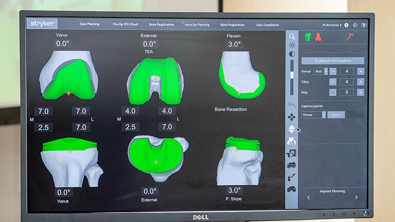 Der Computer gibt exakt vor, wie das Prothesenbett gesägt werden muss. Der Bereich, der für das Implantat weggesägt werden muss, ist auf den Monitoren grün markiert. Der Roboterarm lässt den Operateur dann nur innerhalb des vorgegebenen Bereichs sägen.