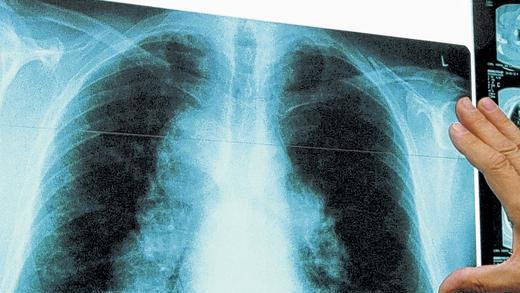 Röntgenbild einer Lunge: Lungenhochdruck hat sehr unspezifische Symptome. Röntgenbild einer Lunge: Lungenhochdruck hat sehr unspezifische Symptome.