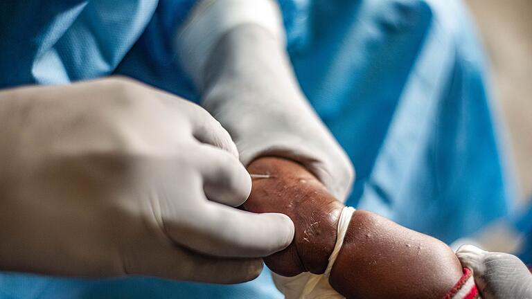 Mpox-Ausbrüche - Kongo       -  Mpox breitet sich in Afrika derzeit immer mehr aus. Hier wird ein Kind behandelt. (Archivbild)