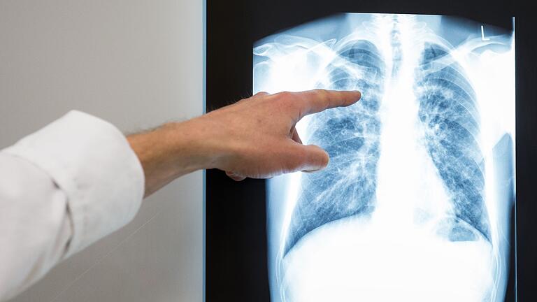 WHO-Tuberkulosebericht - TB war 2023 unter Infektionskrankheiten die häufigste Todesursache. WHO-Tuberkulosebericht - TB war 2023 unter Infektionskrankheiten die häufigste Todesursache.