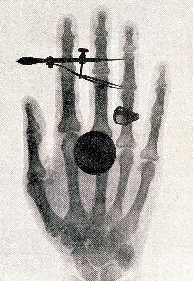 Röntgenaufnahme von Bertha Röntgens Hand aus dem Jahr 1896.
