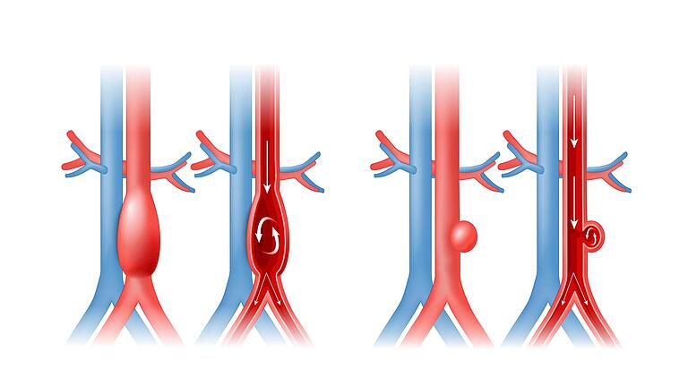 Zwei Arten eines Aortenaneurysmas: Ein ballonförmiges und ein einseitiges Aneurysma.