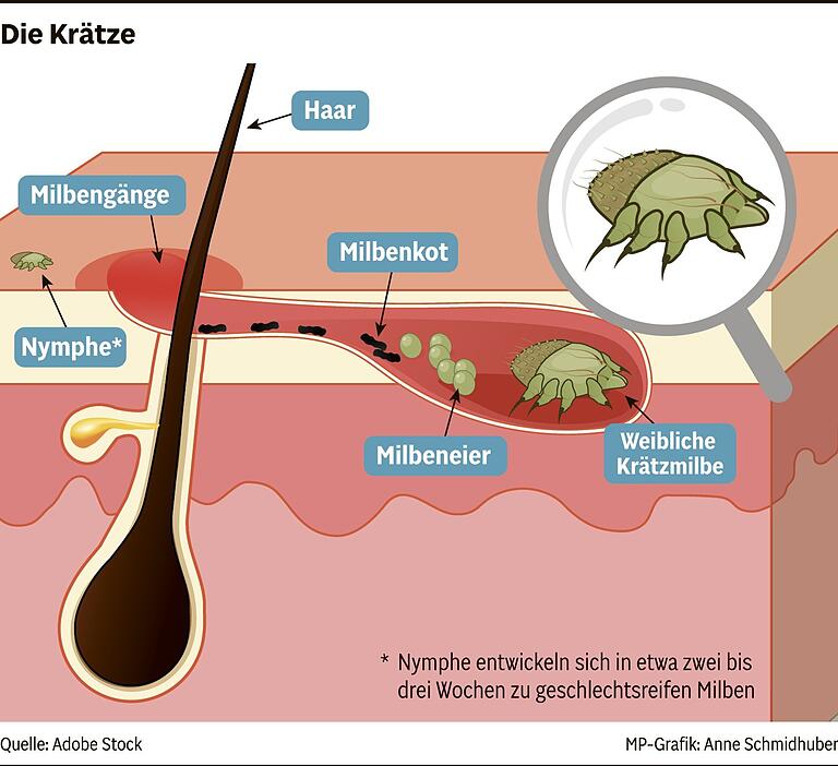 Unterschätzte Hautkrankheit Krätze: Warum Sauberkeit allein nicht schützt Unterschätzte Hautkrankheit Krätze: Warum Sauberkeit allein nicht schützt